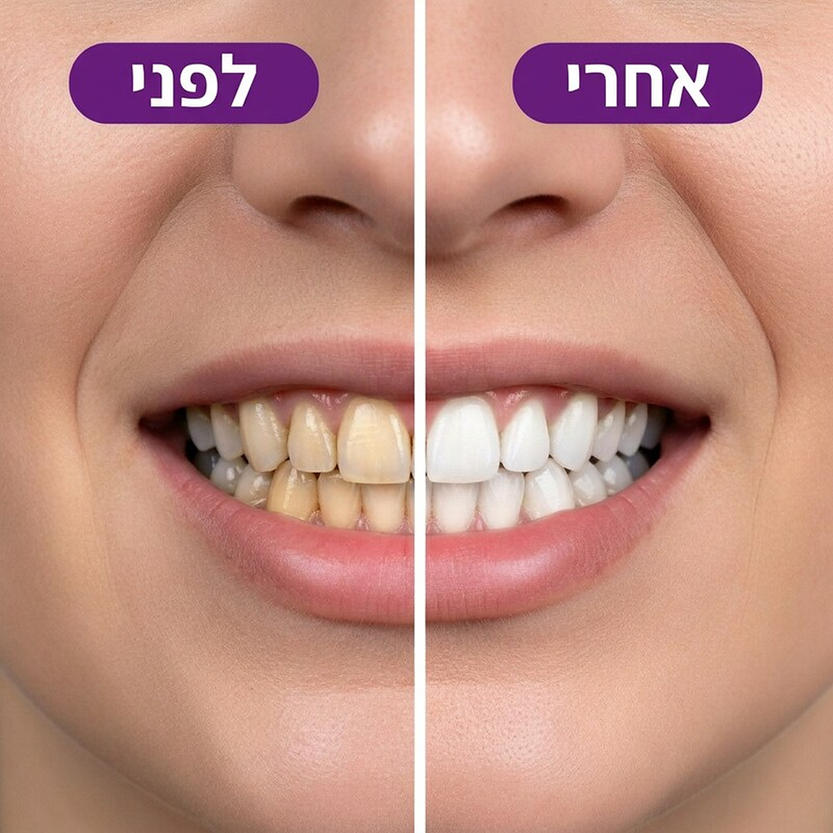 לפני ואחרי שימוש ברצועות ההלבנה